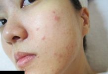 Hướng dẫn rửa mặt bằng nước muối sinh lý vừa trị mụn và làm đẹp da Hướng dẫn rửa mặt bằng nước muối sinh lý vừa trị mụn và làm đẹp da