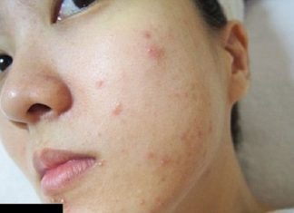 Hướng dẫn rửa mặt bằng nước muối sinh lý vừa trị mụn và làm đẹp da Hướng dẫn rửa mặt bằng nước muối sinh lý vừa trị mụn và làm đẹp da