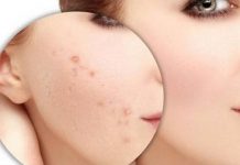 Cách trị mụn ẩn dưới da bằng dầu dừa hiệu quả tri-mun-an-duoi-da-bang-dau-dua