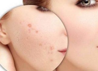 Cách trị mụn ẩn dưới da bằng dầu dừa hiệu quả tri-mun-an-duoi-da-bang-dau-dua