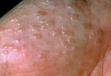 Bạn đã biết cách trị mụn nước ở tay thế nào cho đúng? cách trị mụn nước ở tay 1