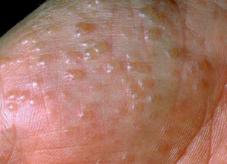 Bạn đã biết cách trị mụn nước ở tay thế nào cho đúng? cách trị mụn nước ở tay 1