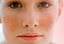 Đơn giản nhưng hiệu quả thần kì với cách trị nám da bằng trứng gà trị nám da bằng trứng gà