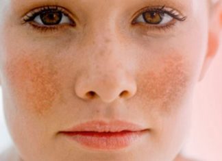 Đơn giản nhưng hiệu quả thần kì với cách trị nám da bằng trứng gà trị nám da bằng trứng gà