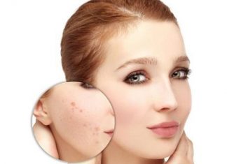 Các cách chăm sóc da mặt bị mụn và thâm tại nhà tốt nhất Các cách chăm sóc da mặt bị mụn và thâm tại nhà tốt nhất