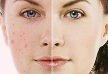 Sở hữu làn da đẹp vạn người mê với cách làm mặt nạ trị thâm mụn cách làm mặt nạ trị thâm mụn