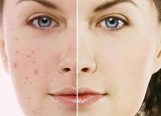 Sở hữu làn da đẹp vạn người mê với cách làm mặt nạ trị thâm mụn cách làm mặt nạ trị thâm mụn