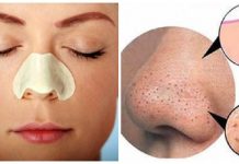 6 cách trị mụn đầu đen ở mũi hiệu quả và siêu an toàn tại nhà 6 cách trị mụn đầu đen ở mũi hiệu quả và siêu an toàn tại nhà