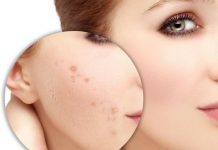 Các cách trị sẹo mụn hiệu quả tại nhà đơn giản đến ngỡ ngàng Cách trị sẹo mụn hiệu quả tại nhà