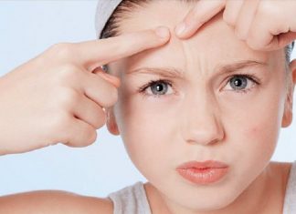 Mụn là gì? Có những cách nào điều trị mụn nhanh chóng? Mụn là gì? Có những cách nào điều trị mụn nhanh chóng?