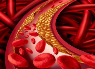 Cách giảm mỡ máu bằng “thần dược” tỏi đen hiệu quả tại nhà Cách giảm mỡ máu bằng "thần dược" tỏi đen hiệu quả tại nhà