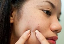 10+ Cách trị mụn ở má từ thiên nhiên hiệu quả chỉ sau 2 tuần