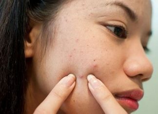 10+ Cách trị mụn ở má từ thiên nhiên hiệu quả chỉ sau 2 tuần