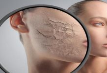 Mách bạn 12 cách trị nẻ mặt hiệu quả nhất hiện nay Mách bạn 12 cách trị nẻ mặt hiệu quả nhất hiện nay