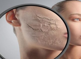 Mách bạn 12 cách trị nẻ mặt hiệu quả nhất hiện nay Mách bạn 12 cách trị nẻ mặt hiệu quả nhất hiện nay