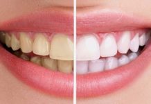 12 cách tẩy trắng răng giúp bạn sở hữu nụ cười tỏa sáng 12 cách tẩy trắng răng giúp bạn sở hữu nụ cười tỏa sáng