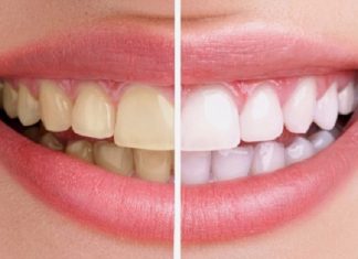 12 cách tẩy trắng răng giúp bạn sở hữu nụ cười tỏa sáng 12 cách tẩy trắng răng giúp bạn sở hữu nụ cười tỏa sáng