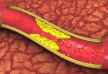 Người mỡ máu có nên uống sữa không? Chế độ ăn lành mạnh dành cho người bị mỡ máu