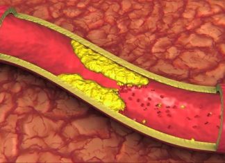 Người mỡ máu có nên uống sữa không? Chế độ ăn lành mạnh dành cho người bị mỡ máu