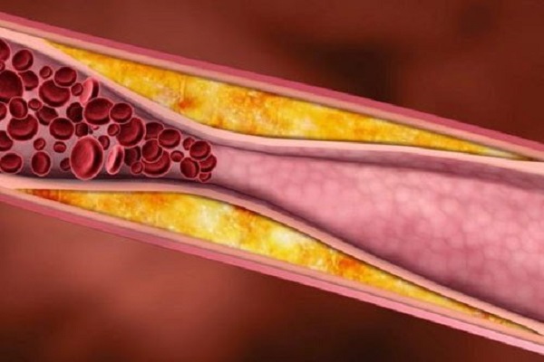 Máu nhiễm mỡ là tình trạng rối loạn chuyển hóa lipid máu