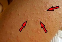 Bật mí cách tiêu diệt viêm lỗ chân lông ở tay tận gốc Bật mí cách chữa viêm lỗ chân lông ở tay tận gốc