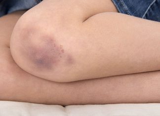 Hướng dẫn cách lăn trứng gà tan máu bầm nhanh chóng cách lăn trứng gà tan máu bầm