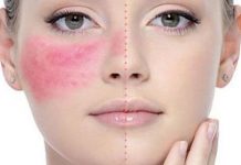 Hướng dẫn 3 cách trị dị ứng da mặt nhanh nhất ngay tại nhà Hướng dẫn 3 cách trị dị ứng da mặt nhanh nhất ngay tại nhà