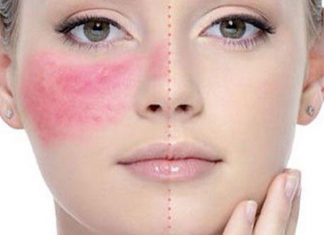 Hướng dẫn 3 cách trị dị ứng da mặt nhanh nhất ngay tại nhà Hướng dẫn 3 cách trị dị ứng da mặt nhanh nhất ngay tại nhà