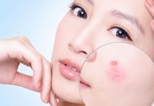 Làm cách nào để điều trị mụn bọc bị chai lâu năm nhanh nhất?