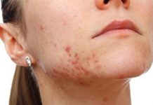 Mụn mọc ở cằm cảnh báo sức khỏe bạn đang gặp vấn đề gì? Mụn mọc ở cằm cảnh báo sức khỏe bạn đang gặp vấn đề gì?