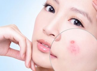 Sản phẩm của hãng Bijindo có tốt không? Trị mụn và cải thiện vết thâm do mụn