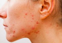 Chia sẻ cách trị mụn đỏ đơn giản và hiệu quả nhất! Cách trị mụn đỏ hiệu quả