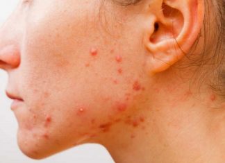 Chia sẻ cách trị mụn đỏ đơn giản và hiệu quả nhất! Cách trị mụn đỏ hiệu quả