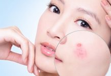 Tổng hợp 7 cách trị mụn dân gian đơn giản và hiệu quả Cách trị mụn dân gian hiệu quả