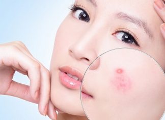 Tổng hợp 7 cách trị mụn dân gian đơn giản và hiệu quả Cách trị mụn dân gian hiệu quả