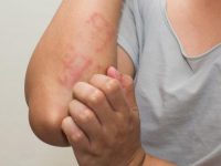 Nguyên nhân bị dị ứng và cách chữa dị ứng tại nhà
